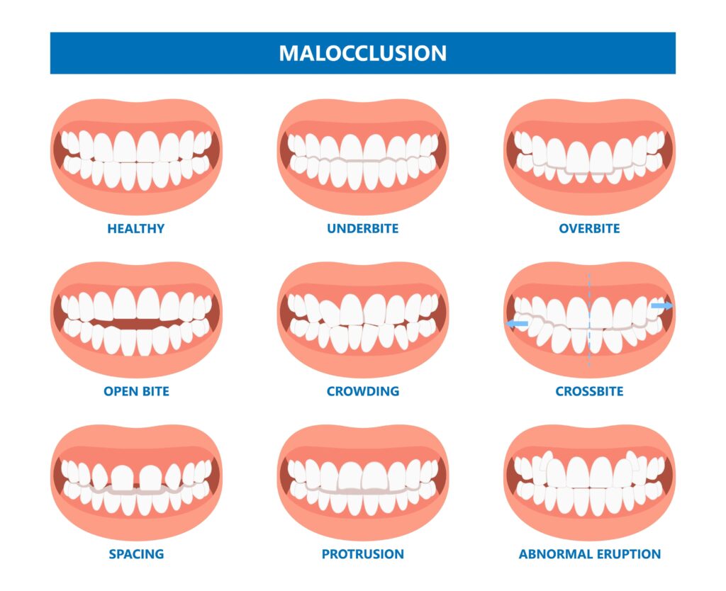 Invisalign treatment options