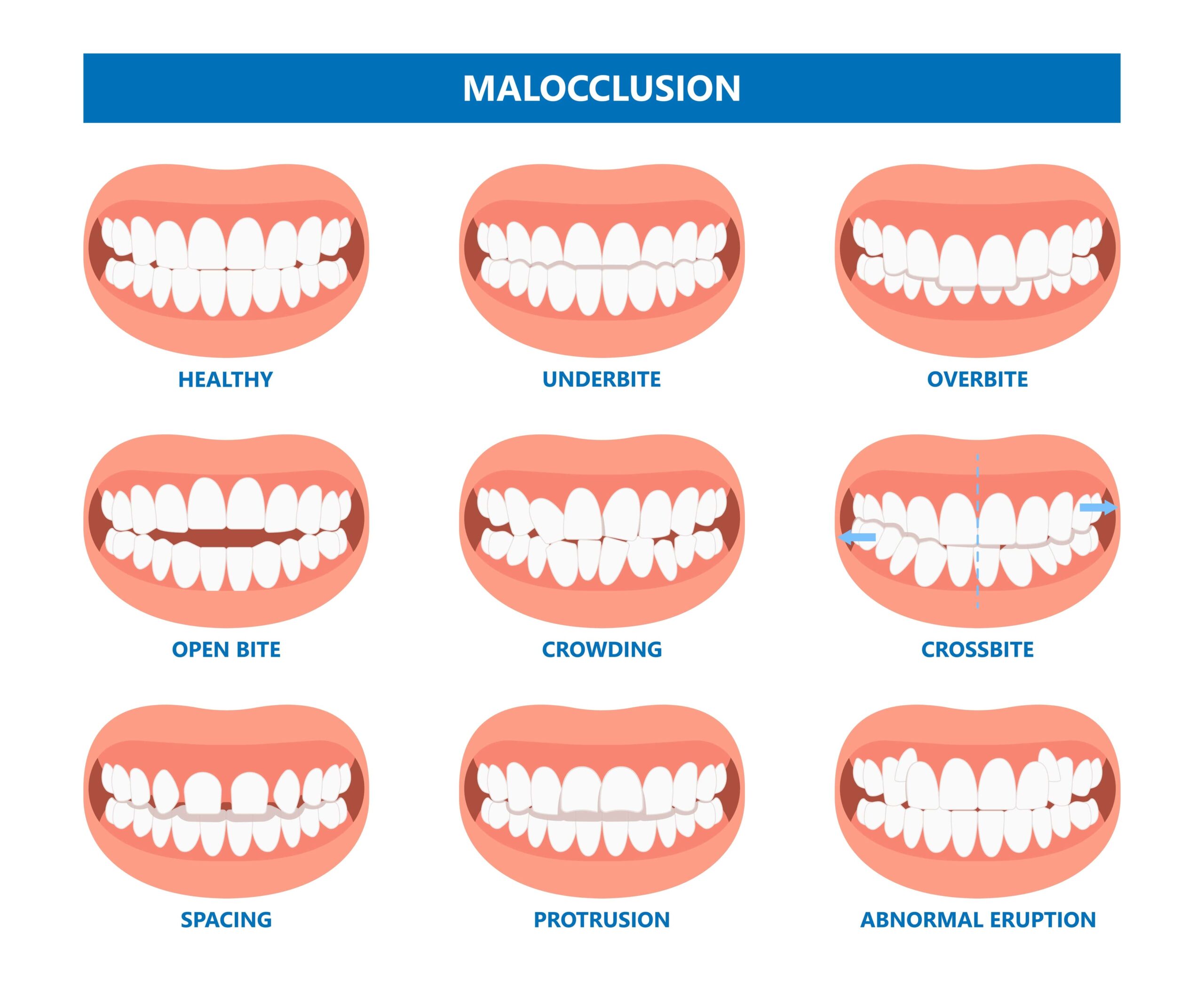 Overbite Correction, No Braces or Invisalign®, No Surgery in 8